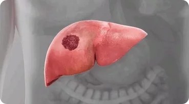 To Avoid Liver Cancer, Stay Away From These Things If you Desire to Live Long