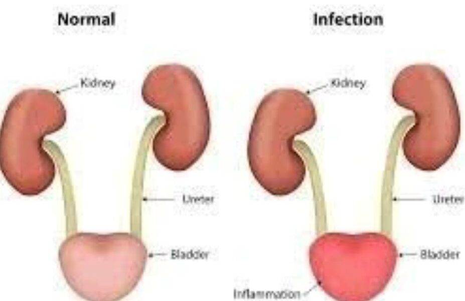 Urinary Tract Disease Kill Fast: Avoid Taking Too Much Of These 3 Things If You Want To Live Longer.