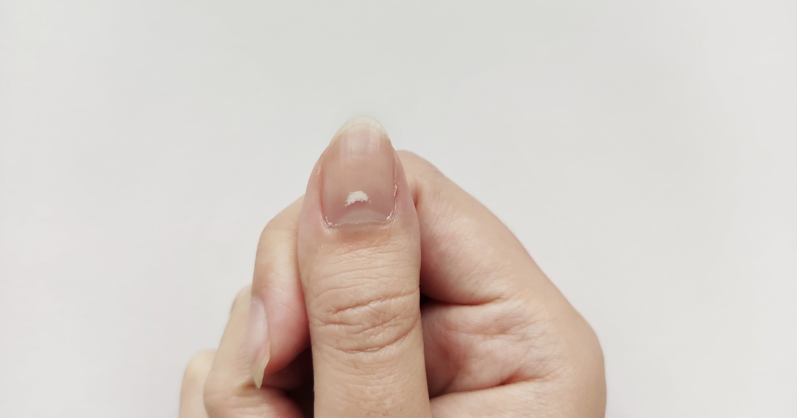 What Are Those White Spots on Your Nails?